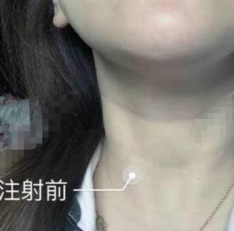 周燁的去頸紋術(shù)前照片