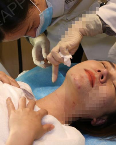 匡妗妮的去頸紋術(shù)前照片