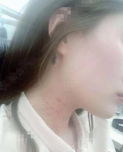 竺豪的去頸紋術(shù)前照片