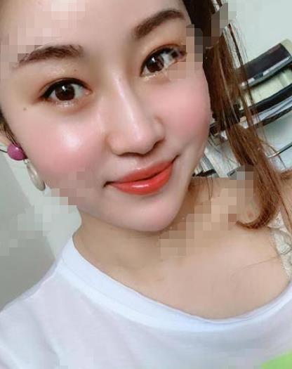 邵鑫磊的去頸紋術(shù)前照片