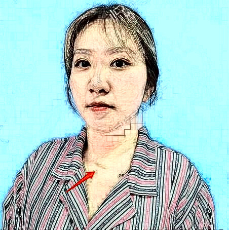 荀睿曦的祛疤術(shù)前照