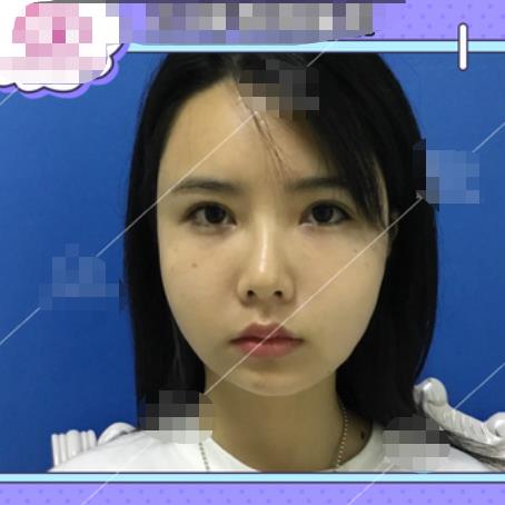 阮月敏的拉皮除皺術(shù)前照片