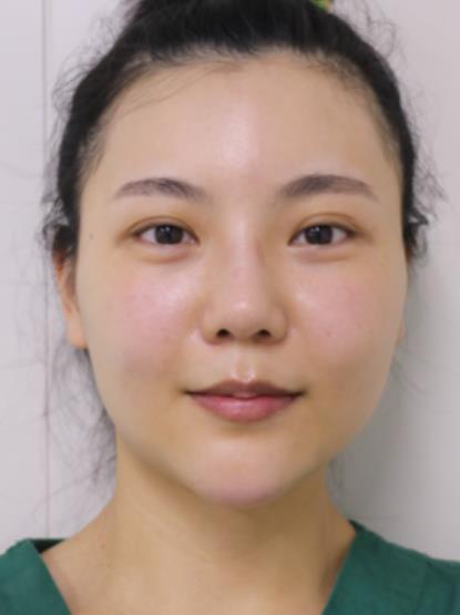 冷兆合的磨骨瘦臉術(shù)前照片