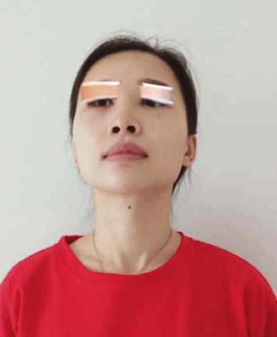 陸董煜的埋線雙眼皮術前照片