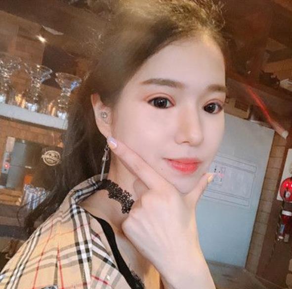 馮梓涵的埋線雙眼皮術(shù)前照片