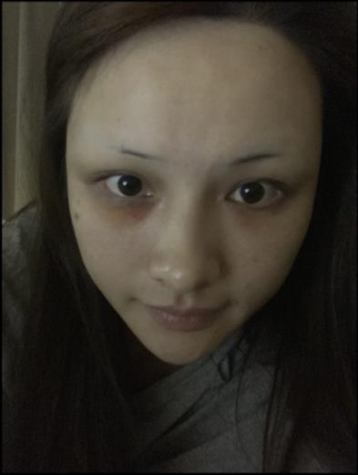 蘆祿鋅的激光去眼袋術(shù)前照片