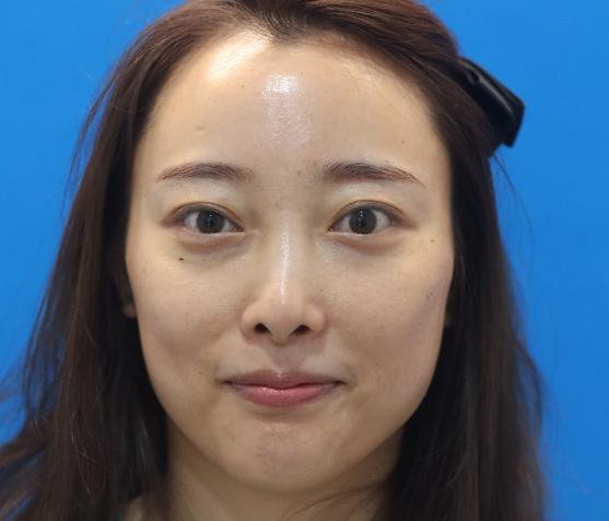 杜家慶的去眼袋術(shù)前照片