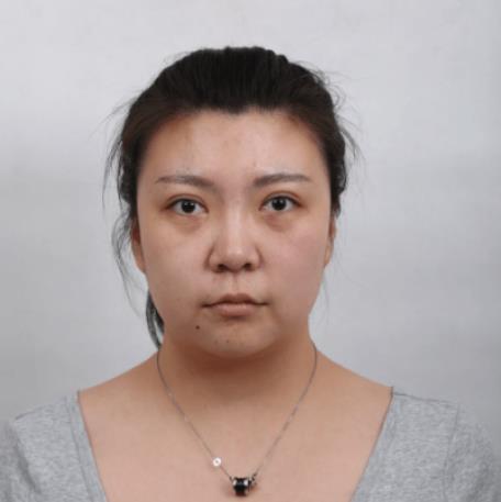 冼康靖的去眼袋術(shù)前照片