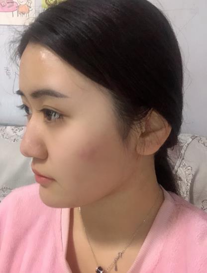 魚世豪的瘦臉針術(shù)前照片