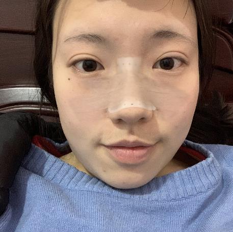 周廷梅的鼻修復(fù)術(shù)前照片