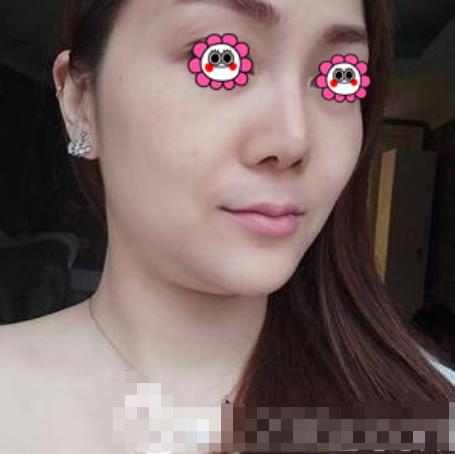 慕雨山的瘦臉針術(shù)前照片