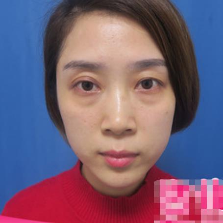 榮澤瑞的去眼袋術(shù)前照片