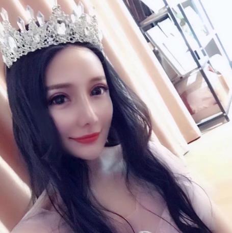 閔義均的隆鼻術(shù)后照片