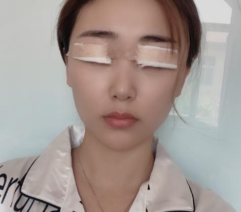 邊垚垚的雙眼皮術(shù)前照片