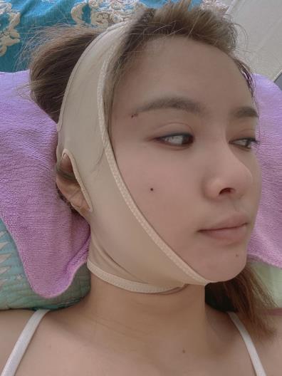 江盼盼的下頜角磨骨術(shù)前照片