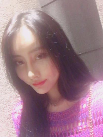 焦蟻江的隆鼻術(shù)后照片