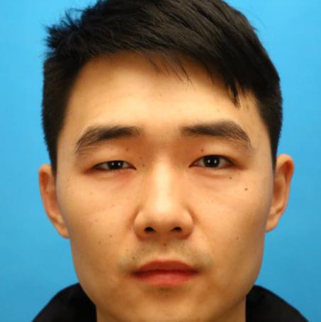 文泠然的雙眼皮術(shù)前照片