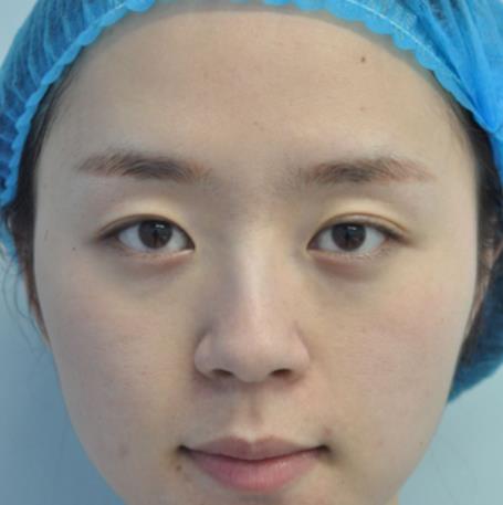 徐藝恬的雙眼皮術(shù)前照片