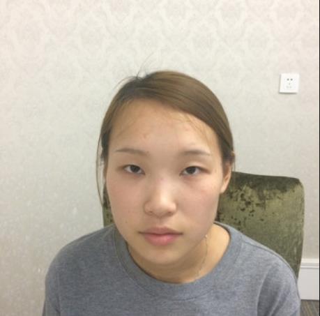 肖靜雅的雙眼皮術(shù)前照片