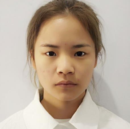 幸裕博的埋線雙眼皮術前照片