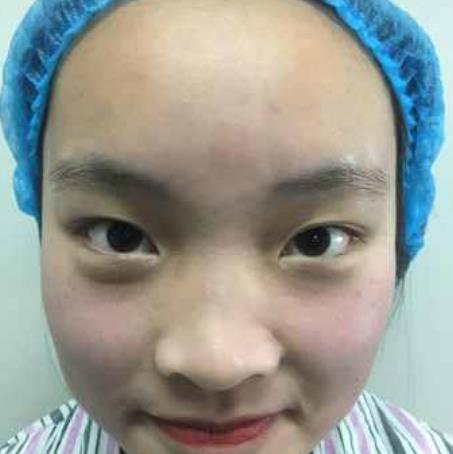 廖瑞軒的全切雙眼皮術(shù)前照片