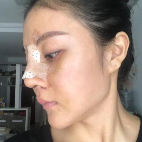 艾虹哲的隆鼻修復(fù)術(shù)前照片