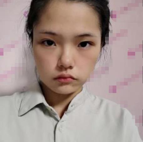 溫雨諾的面部拉皮術(shù)前照片