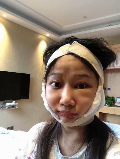 陰棋明的下頜角磨骨術(shù)前照片