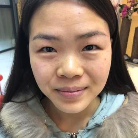 嚴奕文的隆鼻術(shù)前照片