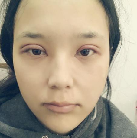 陶恩楠的雙眼皮術(shù)前照片