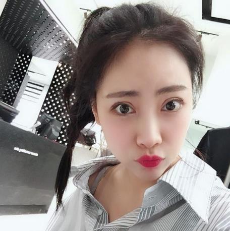 饒博磊的雙眼皮術(shù)后照片