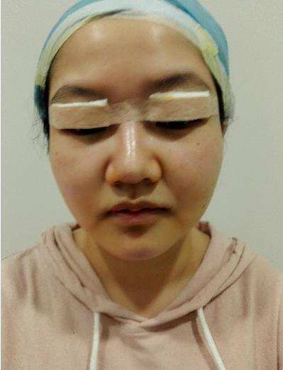 應(yīng)弈樂的全切雙眼皮術(shù)前照片