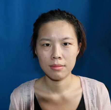 李洽的雙眼皮術(shù)前照