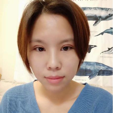 李洽的雙眼皮術(shù)后照