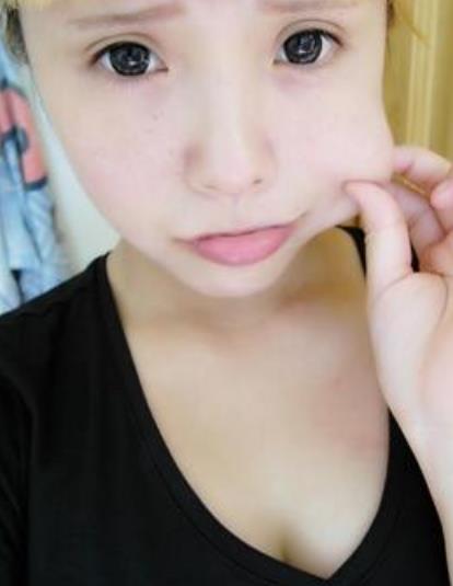 湯晨軒的瘦臉針術(shù)前照片