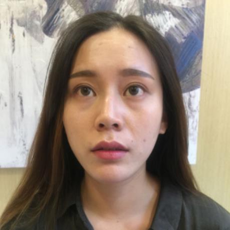 苑玉蘭的去眼袋術(shù)前照