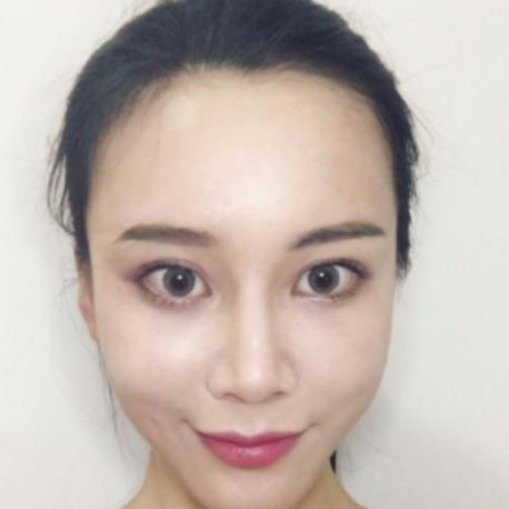 苑玉蘭的去眼袋術(shù)后照