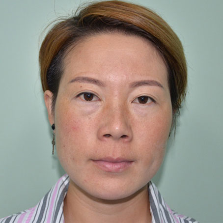 向昊澤的去眼角紋術(shù)前照片