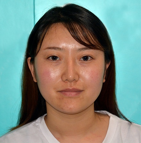 麻慶的去眼角紋術前照片