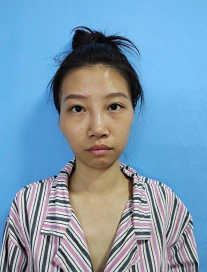 白宸茜的面部拉皮術(shù)前照片