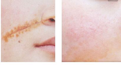 名醫(yī)協(xié)和袁泉醫(yī)生專治肌膚，走紅網(wǎng)絡！詳解成功案例與費用攻略，值得留意！