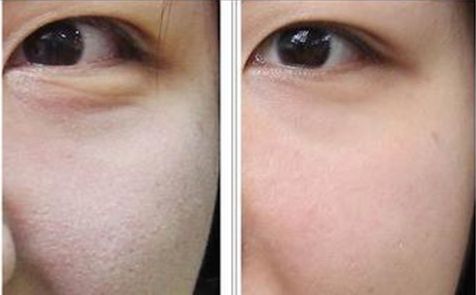 長(zhǎng)沙湘雅醫(yī)院豐胸效果觸動(dòng)人心！2023奇跡曝光