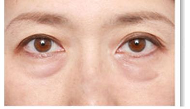 南昌二附院易陽艷雙眼皮手術效果欣賞，術后一個月如何恢復？