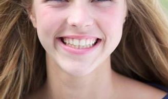 大連愛德麗格整容術(shù)后修復(fù)之雙眼皮失敗案例分享