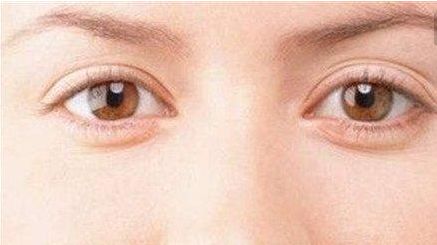 杭州美萊韓超雙眼皮手術的價格如何？看看真實手術效果圖和費用信息！