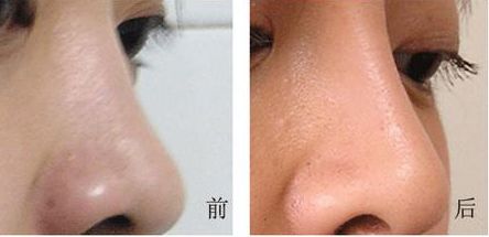 西部戰(zhàn)區(qū)總醫(yī)院美容科術(shù)后效果驚艷，獨家案例曝光