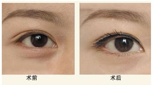 鄭州二附院韓國技術墊鼻真實感受揭秘