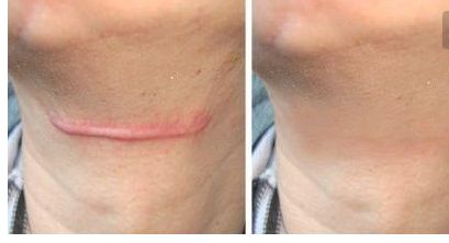 成都新麗美整形醫(yī)院靠譜嗎？隆胸案例更新值得參考