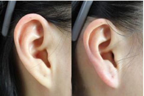 吳焱秋雙眼皮修復經驗分享，完美修復雙眼皮毀容案例分析