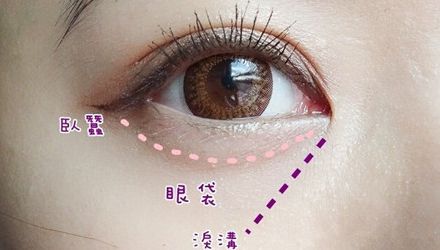 寧波汪臘雙眼皮案例詳細(xì)解讀！知名眼科醫(yī)院名醫(yī)娓娓分享，整形價(jià)格透明公開！